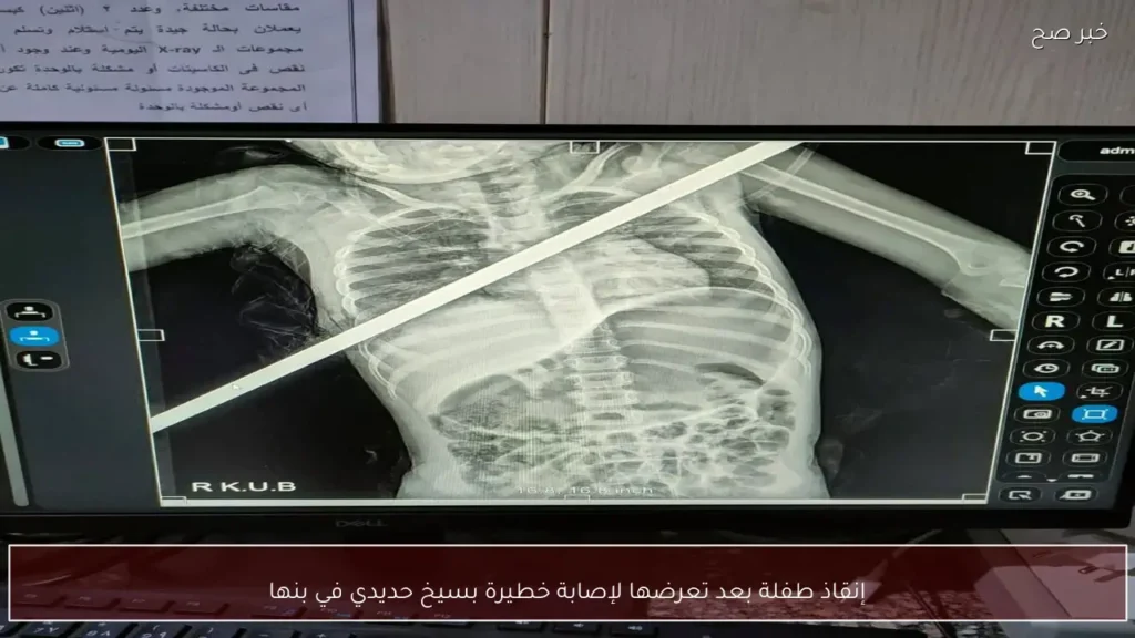 إنقاذ طفلة بعد تعرضها لإصابة خطيرة بسيخ حديدي في بنها