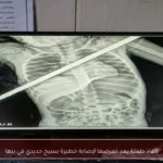 إنقاذ طفلة بعد تعرضها لإصابة خطيرة بسيخ حديدي في بنها